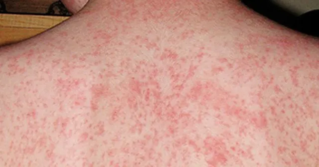 Measles case detected in NSW